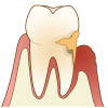 イラスト:細菌が侵入した歯