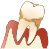 イラスト:歯肉からの出血が起こった歯