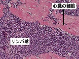 写真:リンパ球が異常に増えている様子